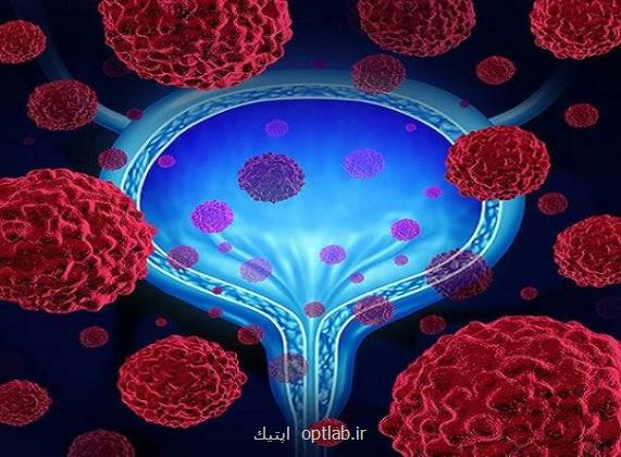 مهم ترین عوامل ایجاد سرطان مثانه